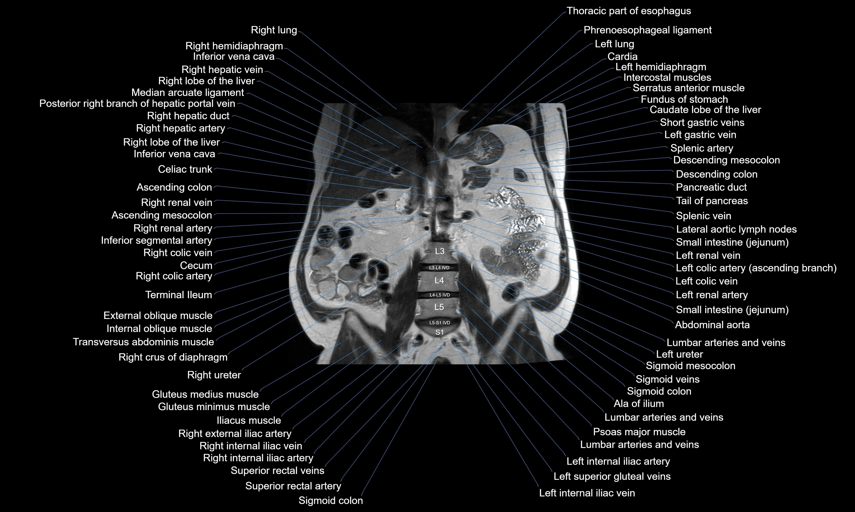 MRI Abdomen axial cross sectional anatomy radiology  image-img-00001-00033.webp